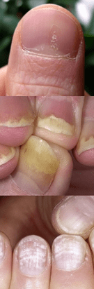 Nagelpsoriasis - Anfangsstadium