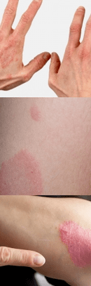 Psoriasis der Anfangsphase in den Händen
