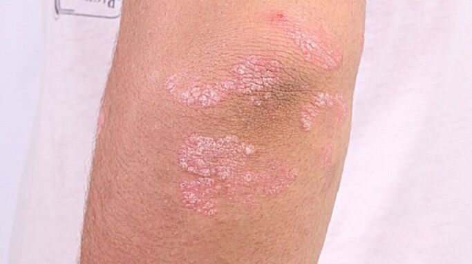Foto von Psoriasis im Frühstadium