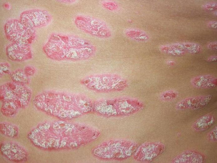 Plaque-Psoriasis