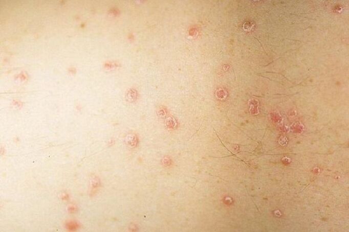 Symptome einer lokalisierten Psoriasis