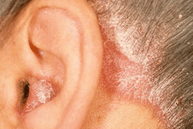 Ursachen der Psoriasis