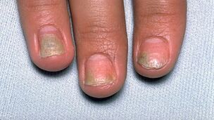 Ursachen für Psoriasis auf den Nägeln